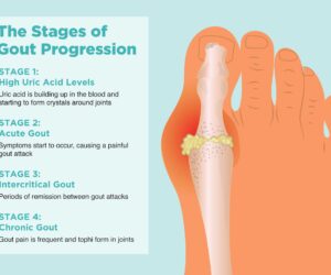 0919_Stages_Gout
